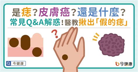 內痣是什麼|是痣？皮膚癌？還是什麼？常見Q&A解惑！醫教揪出「。